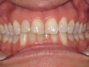 Invisalign Before and After Pictures in Virginia Beach, VA