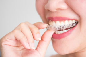 Invisalign in Virginia Beach, VA