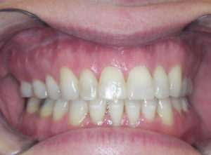 Braces Before and After Pictures Virginia Beach, VA