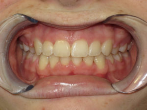 Braces Before and After Pictures Virginia Beach, VA