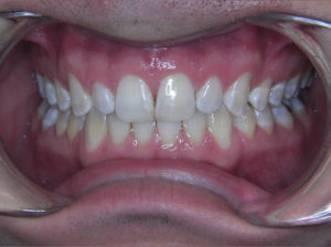 Invisalign Before and After Pictures Virginia Beach, VA