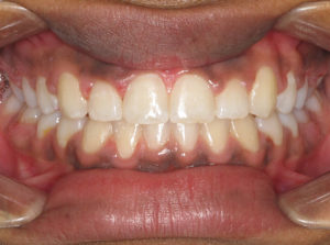 Invisalign Before and After Pictures Virginia Beach, VA