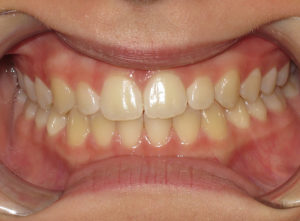 Invisalign Before and After Pictures Virginia Beach, VA