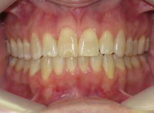 Invisalign Before and After Pictures Virginia Beach, VA