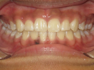 Invisalign Before and After Pictures Virginia Beach, VA