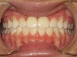Braces Before and After Pictures Virginia Beach, VA