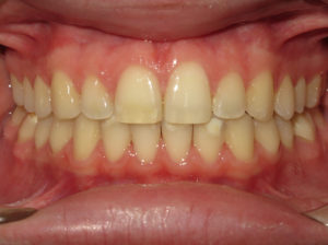 Invisalign Before and After Pictures Virginia Beach, VA