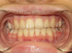 Braces Before and After Pictures in Virginia Beach, VA