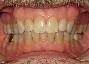 Invisalign Before and After Pictures in Virginia Beach, VA