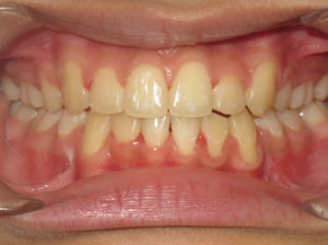 Braces Before and After Pictures Virginia Beach, VA