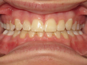 Braces Before and After Pictures in Virginia Beach, VA