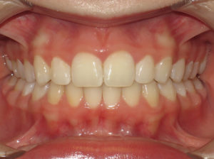 Braces Before and After Pictures in Virginia Beach, VA