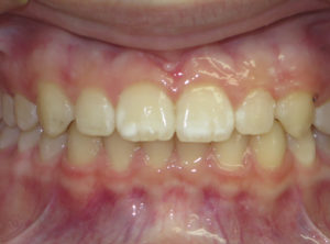 Invisalign Before and After Pictures in Virginia Beach, VA