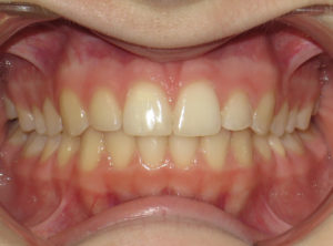 Invisalign Before and After Pictures in Virginia Beach, VA