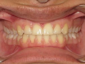 Braces Before and After Pictures in Virginia Beach, VA