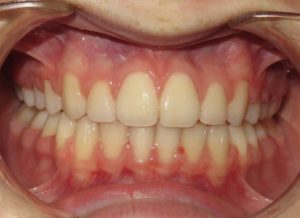 Braces Before and After Pictures in Virginia Beach, VA