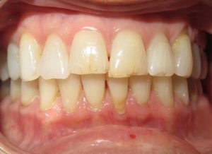 Invisalign Before and After Pictures in Virginia Beach, VA