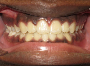 Braces Before and After Pictures Virginia Beach, VA