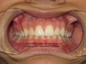 Invisalign Before and After Pictures in Virginia Beach, VA