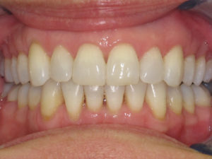 Invisalign Before and After Pictures Virginia Beach, VA