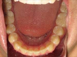 Invisalign Before and After Pictures in Virginia Beach, VA