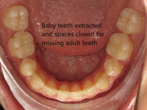 Braces Before and After Pictures in Virginia Beach, VA