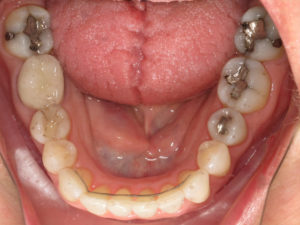 Invisalign Before and After Pictures Virginia Beach, VA