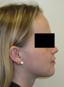 Surgery Before and After Pictures in Virginia Beach, VA