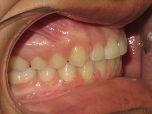 Braces Before and After Pictures in Virginia Beach, VA