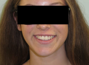 Braces Before and After Pictures Virginia Beach, VA