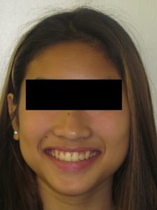 Braces Before and After Pictures Virginia Beach, VA