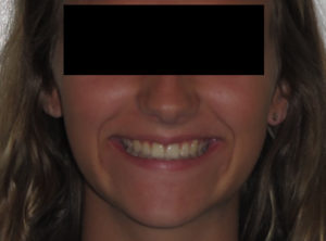 Invisalign Before and After Pictures Virginia Beach, VA