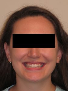 Invisalign Before and After Pictures in Virginia Beach, VA