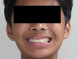 Invisalign Before and After Pictures in Virginia Beach, VA