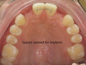 Braces Before and After Pictures in Virginia Beach, VA