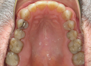 Invisalign Before and After Pictures in Virginia Beach, VA