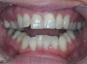 Braces Before and After Pictures Virginia Beach, VA