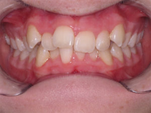 Braces Before and After Pictures Virginia Beach, VA