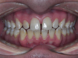 Invisalign Before and After Pictures Virginia Beach, VA