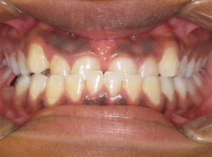 Invisalign Before and After Pictures Virginia Beach, VA