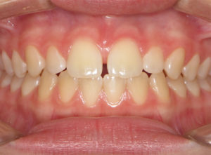 Invisalign Before and After Pictures Virginia Beach, VA