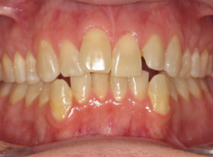 Invisalign Before and After Pictures Virginia Beach, VA