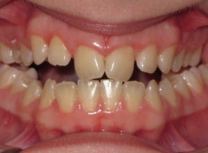 Braces Before and After Pictures Virginia Beach, VA