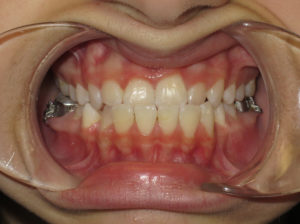 Braces Before and After Pictures Virginia Beach, VA