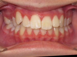 Braces Before and After Pictures Virginia Beach, VA