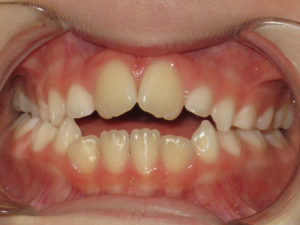 Braces Before and After Pictures Virginia Beach, VA