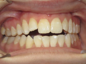 Invisalign Before and After Pictures in Virginia Beach, VA