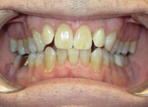 Invisalign Before and After Pictures in Virginia Beach, VA