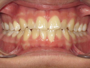 Invisalign Before and After Pictures in Virginia Beach, VA