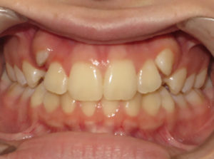 Braces Before and After Pictures in Virginia Beach, VA